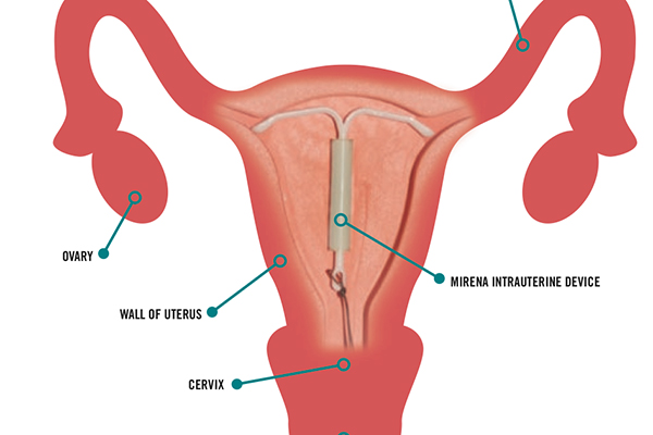 Contraception: The Intra Uterine Device